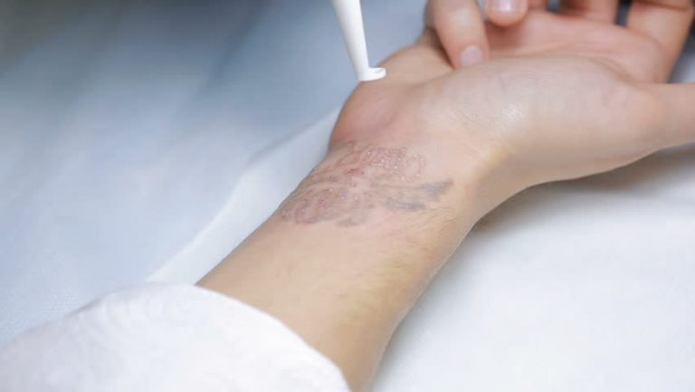 Thinking After Inking: Laser Tattoo Removal Can Help