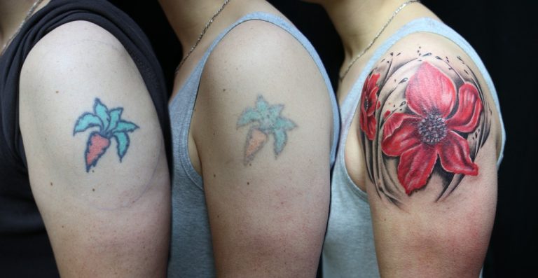 tattoo removal melbourne